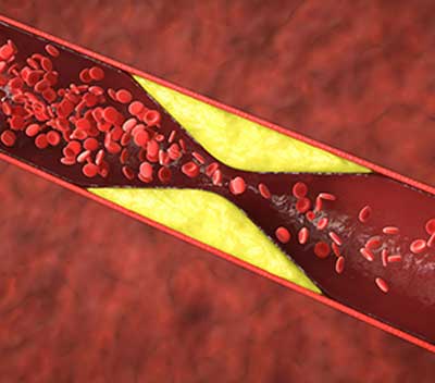 Conoscere l'aterosclerosi